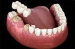 Understanding Dental Bridge Services: A Comprehensive Guide